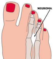 A Neuroma is a painful swollen nerve in the ball of the foot. Illustration Lauri Dowling